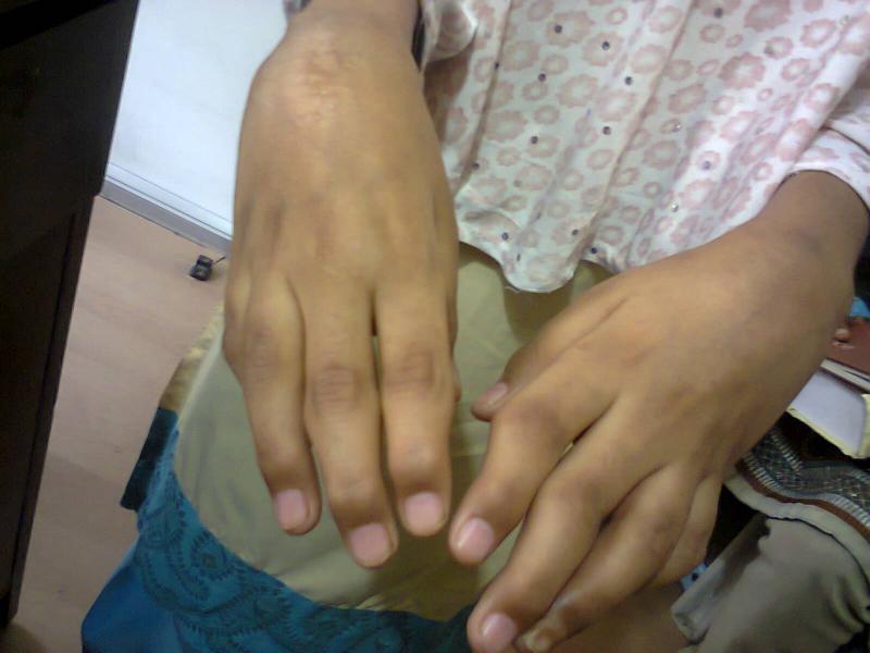 Rheumatoid arthritis with deformities in a young girl